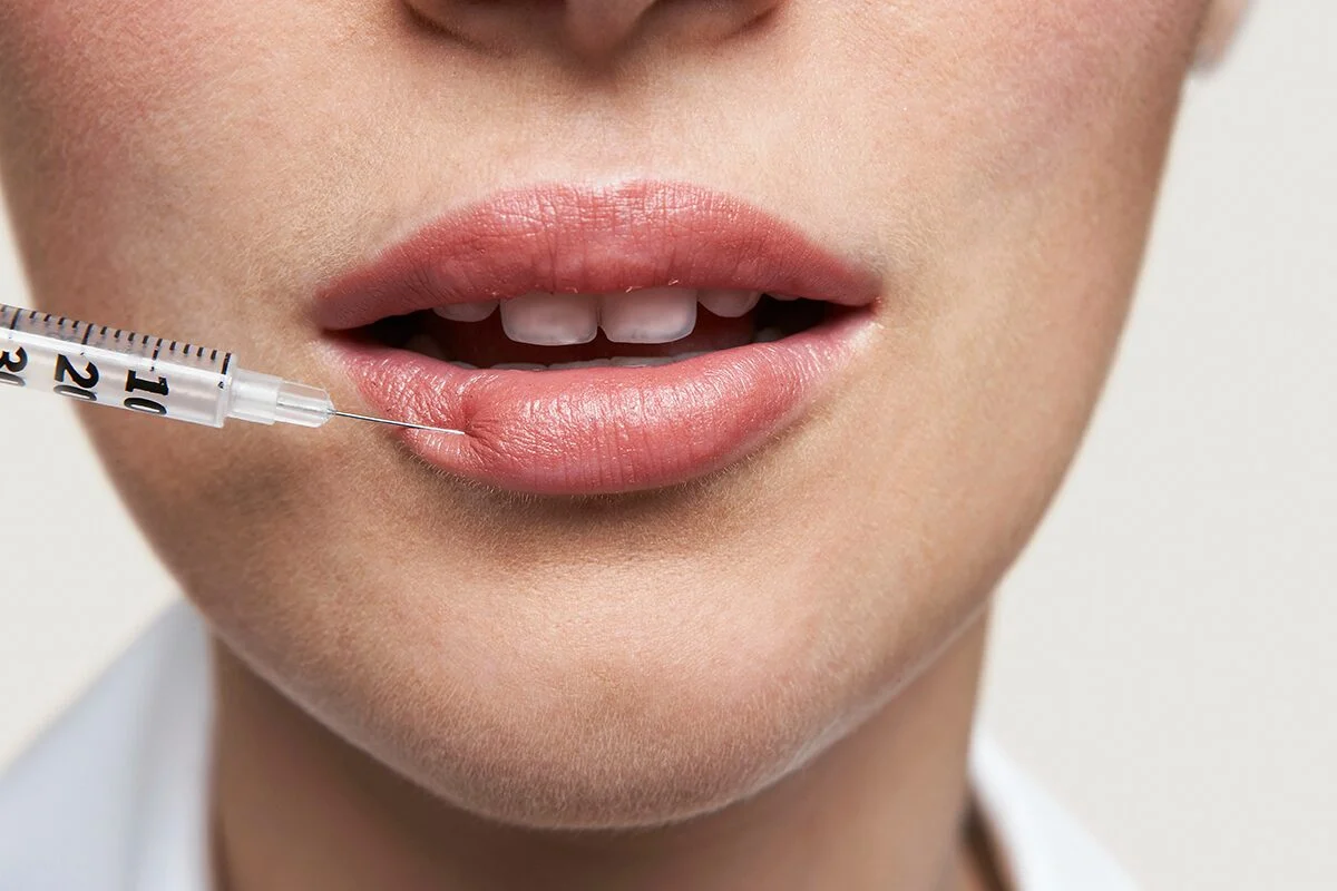 Do Lip Fillers Really Last Forever?
