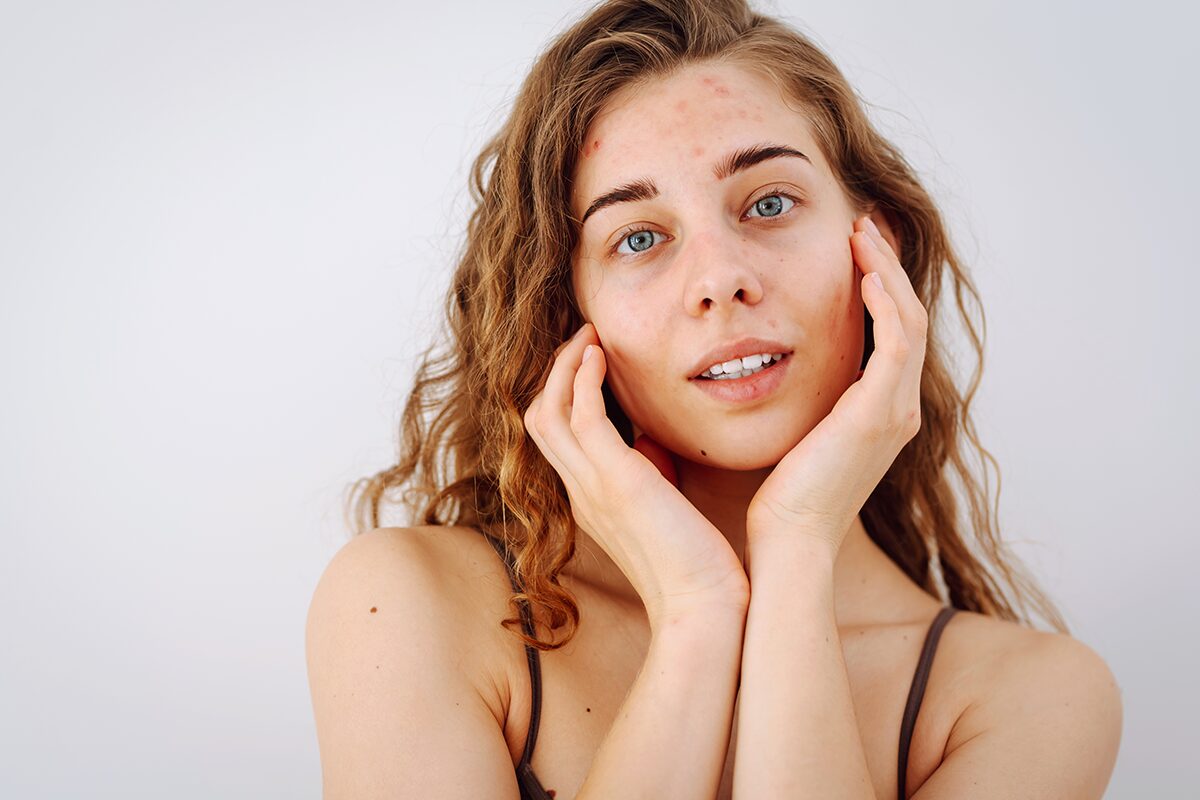 How to treat hormonal acne?