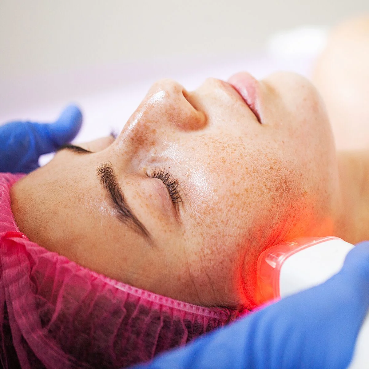 Sessions of microneedling with PRP by Skin Artistry Clinic in Alamo, CA