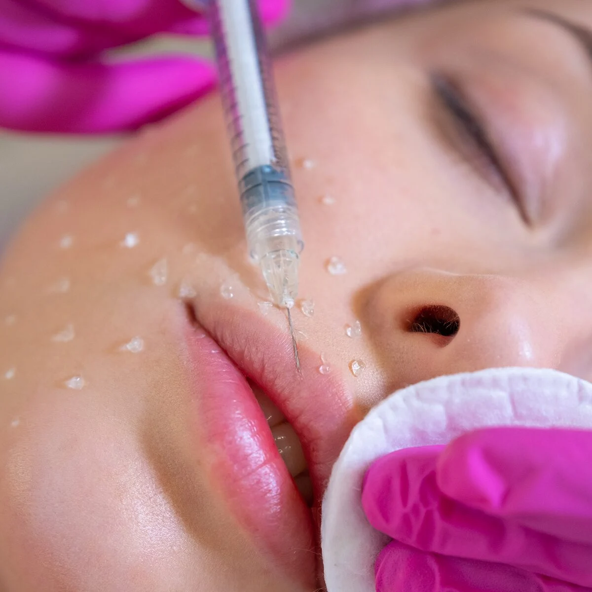How long does microneedling with PRP results last?