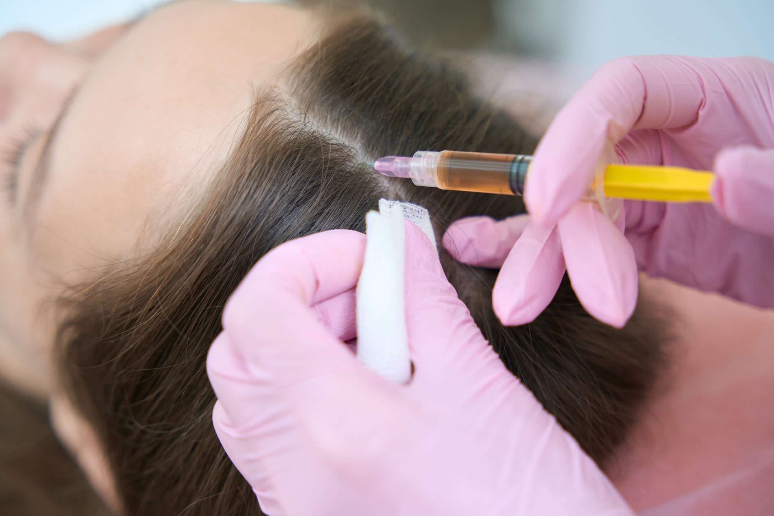 Benefits of Hair PRP