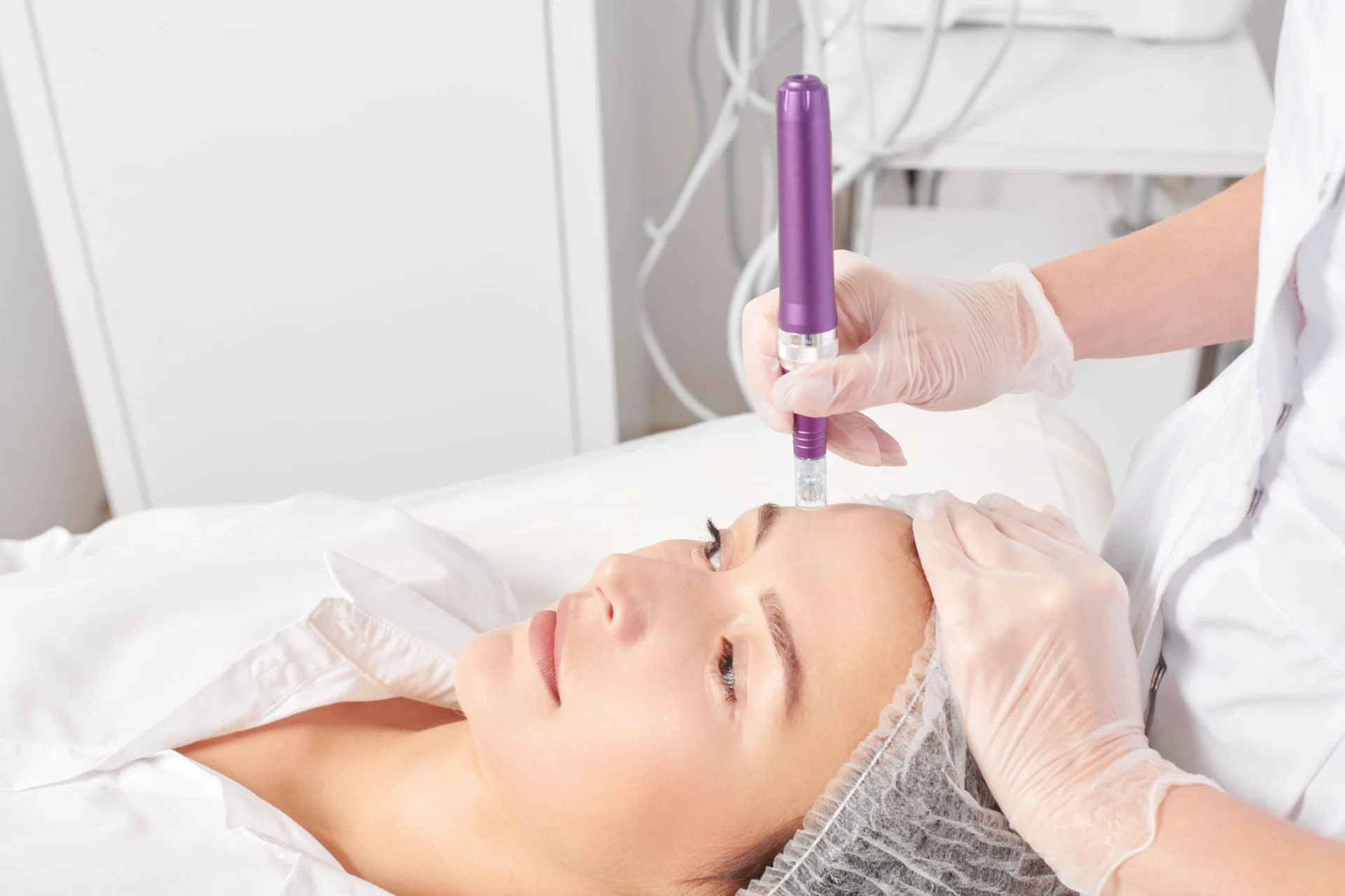 Microneedling With PRP for Stretch Marks