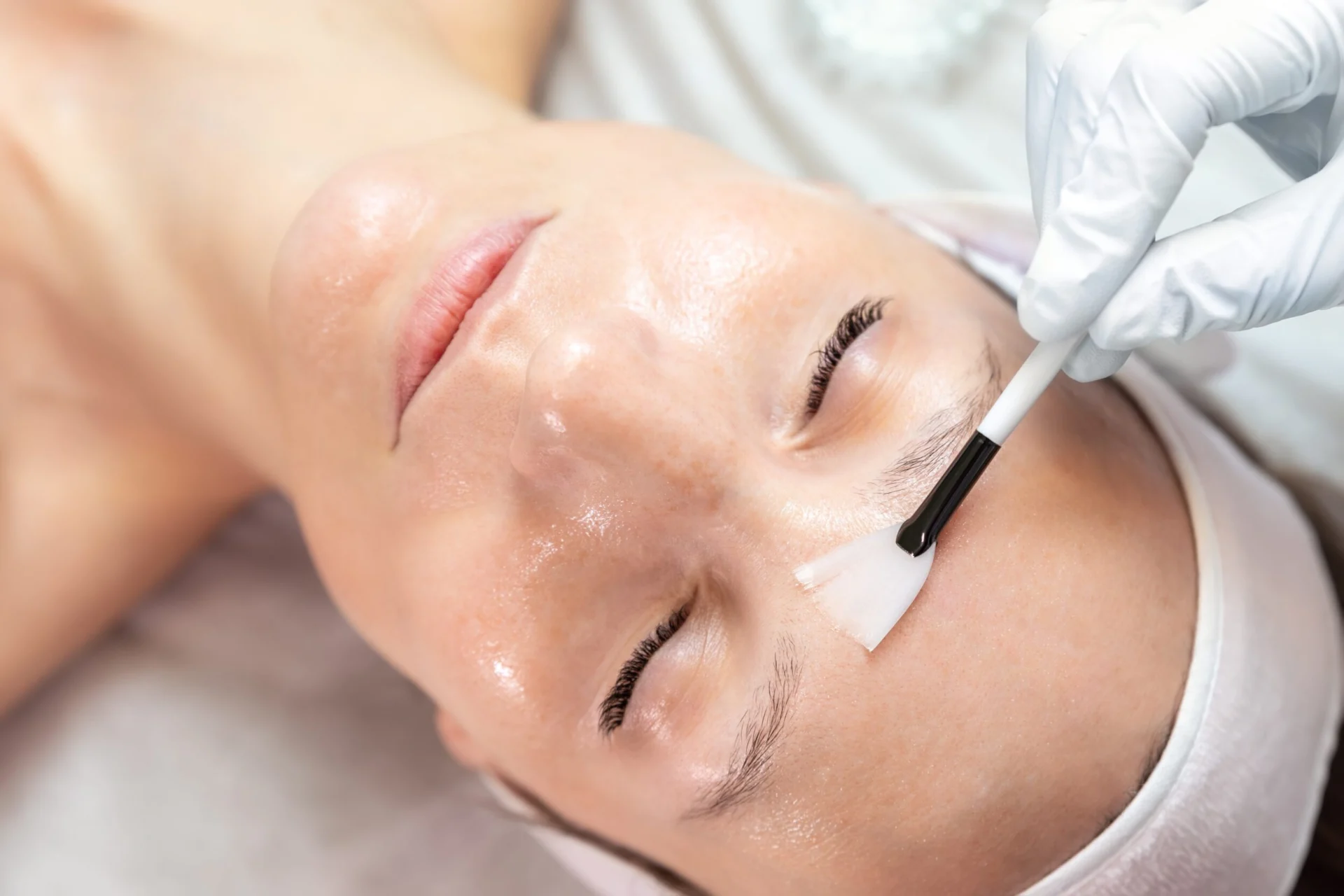 Anti-Aging Chemical Peel Procedure Cost Alamo CA