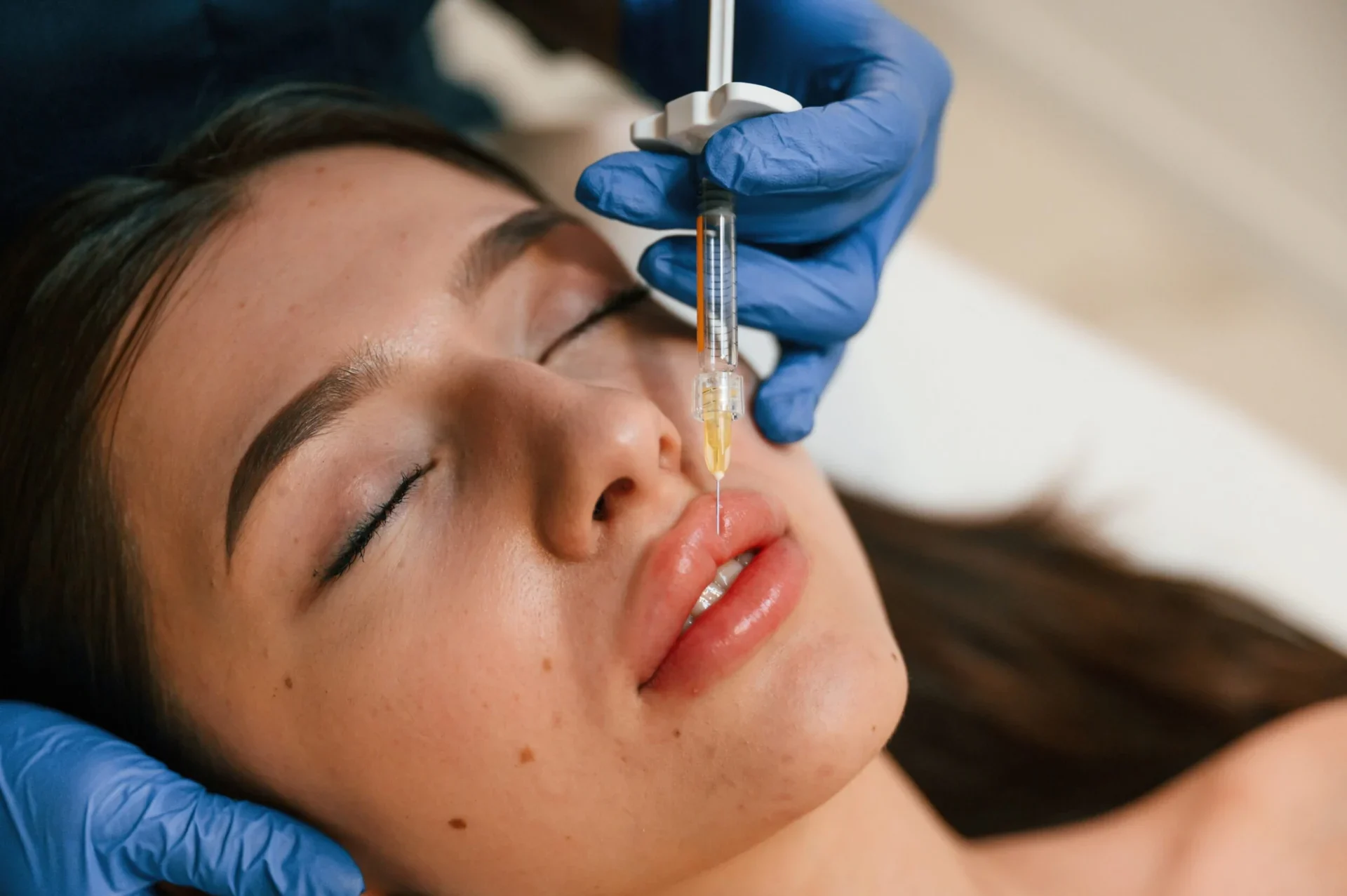 Juvéderm Results For Nasolabial Folds In Alamo CA