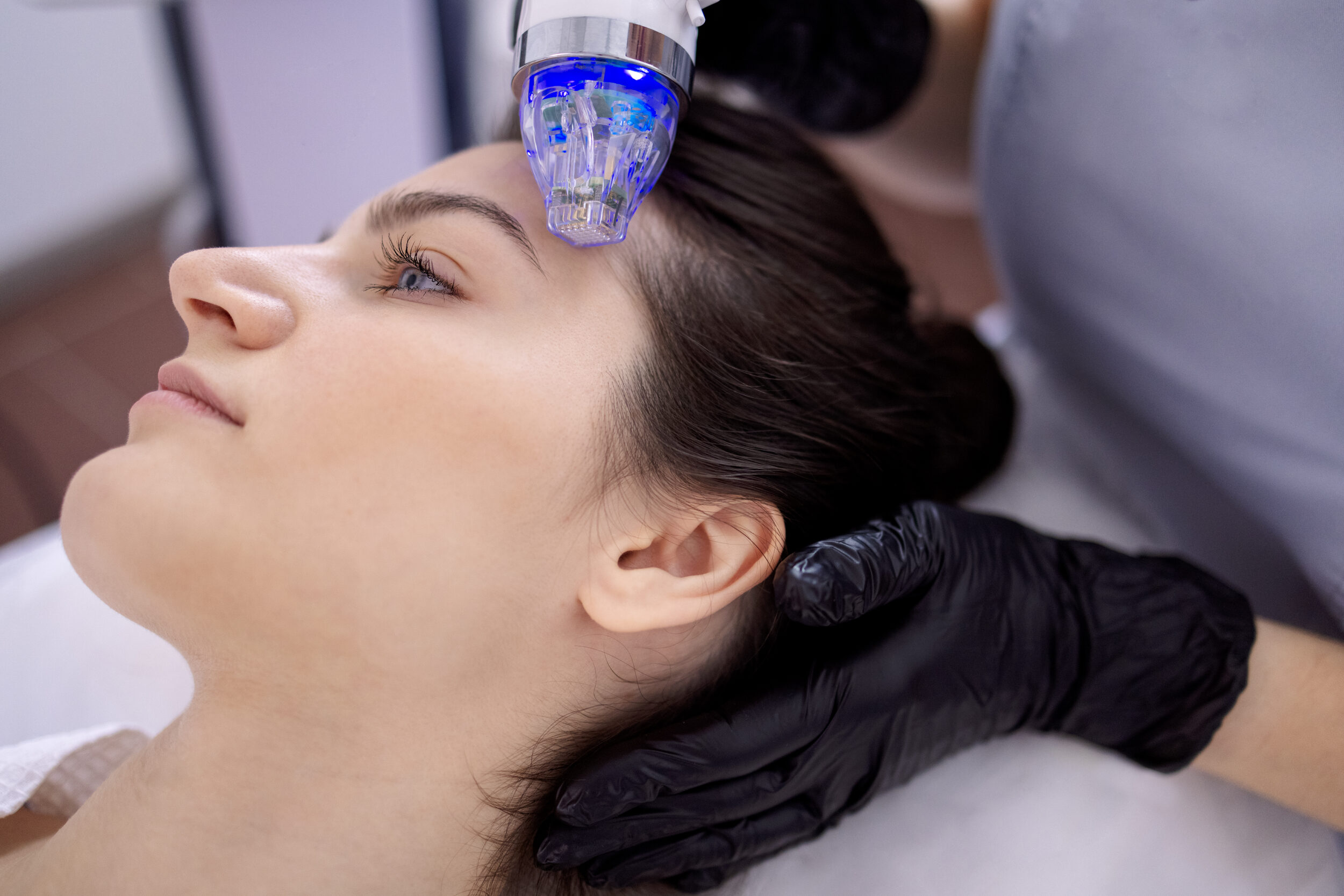 RF Microneedling Procedure for Acne Scars in Alamo Clinic