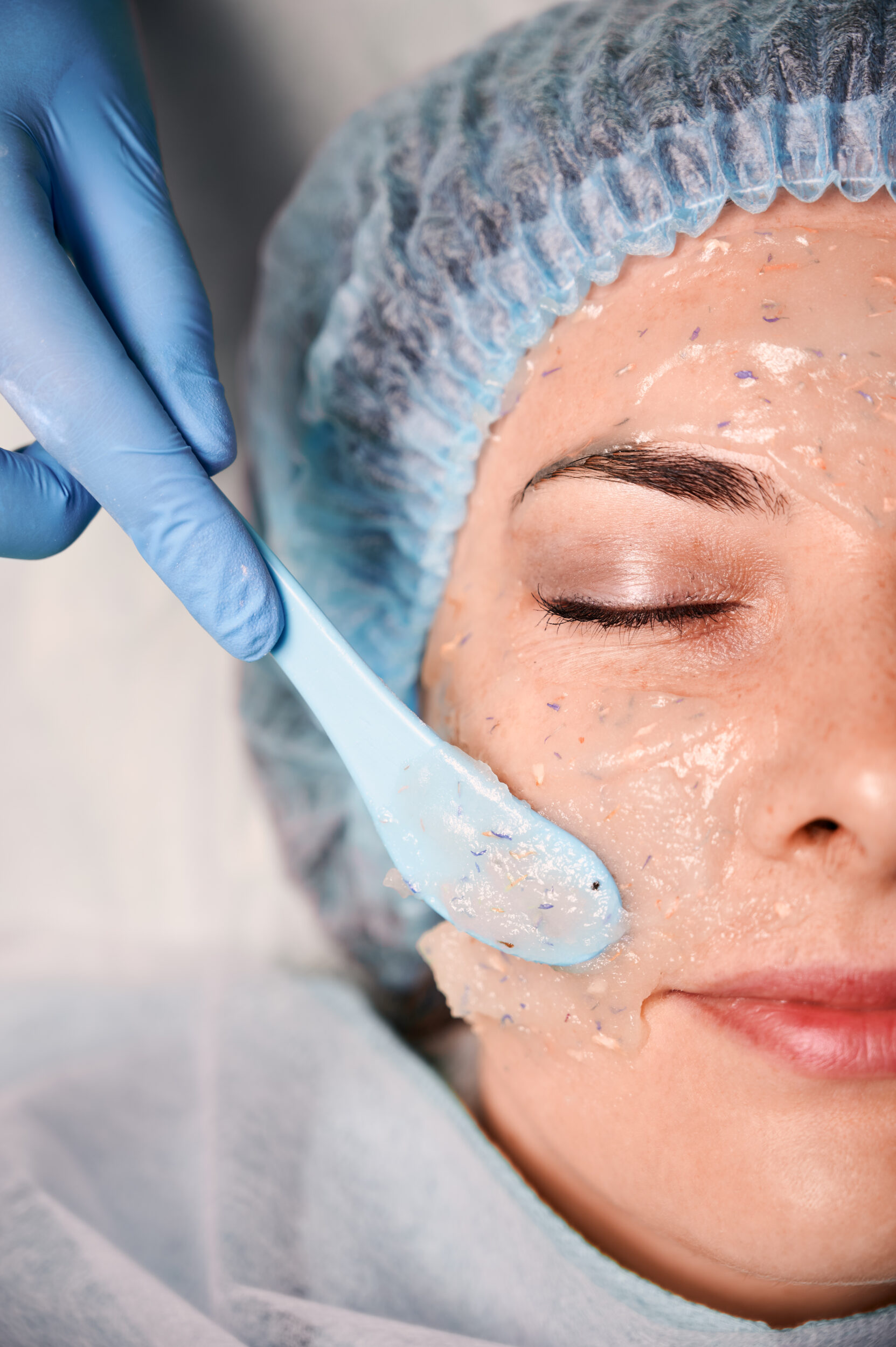 Medical Grade Skin Peel Treatment For Acne Scars