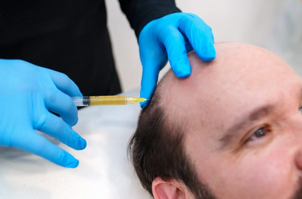 PRP Plus Microneedling for Thinning Hair
