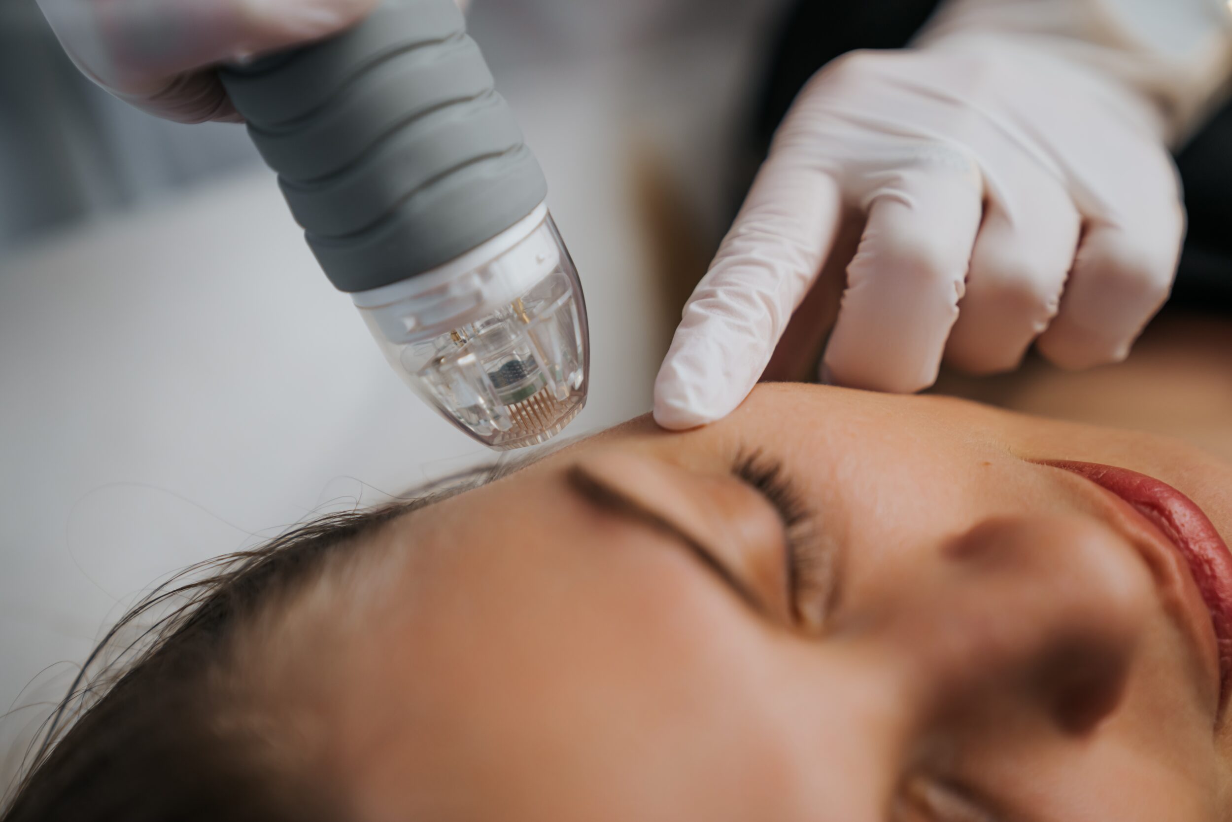 Before and After Results of Rf Microneedling in Alamo CA