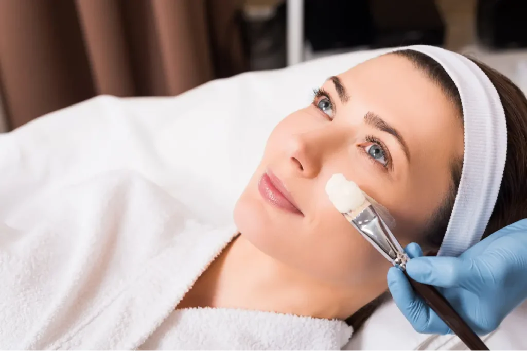 Chemical Peel for Fair Complexion