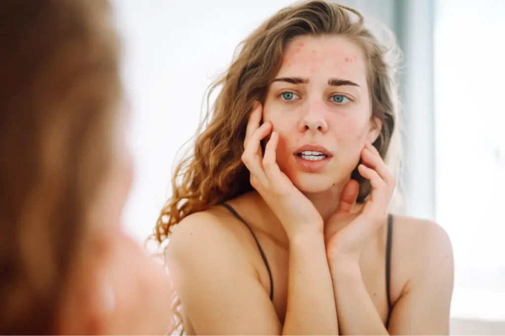 Acne Treatment Procedures