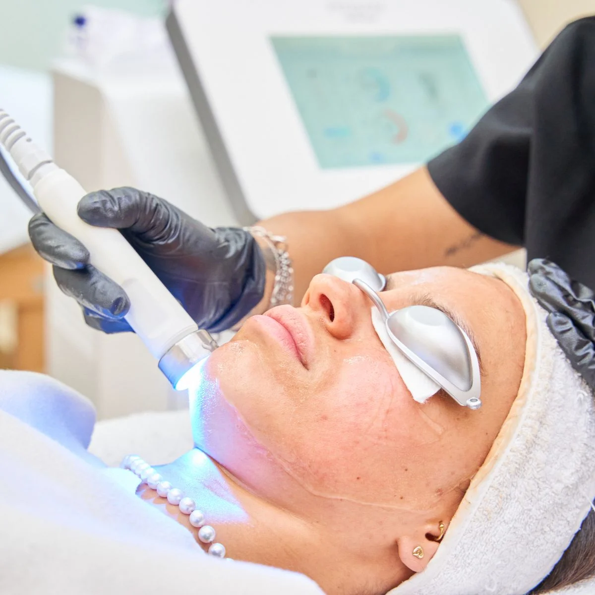 What is the Downside of IPL Treatment
