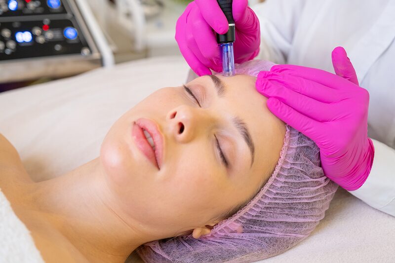 PRP Microneedling Benefits