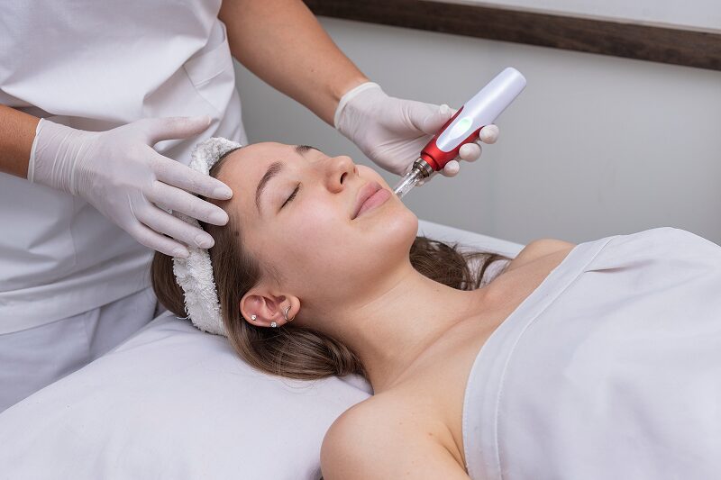 PRP Microneedling Recovery Time