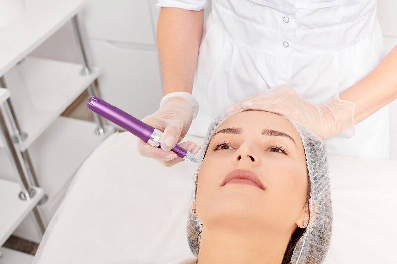 PRP Microneedling For Face