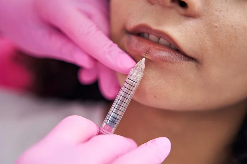 How Long Does Hyaluronic Acid Lip Filler Last