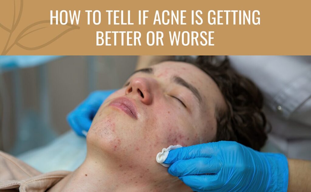 How To Tell If Your Skin Is Purging