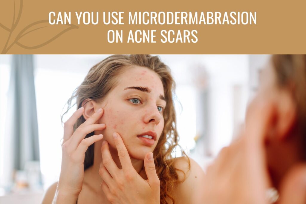 Is Microdermabrasion Good For Pimples