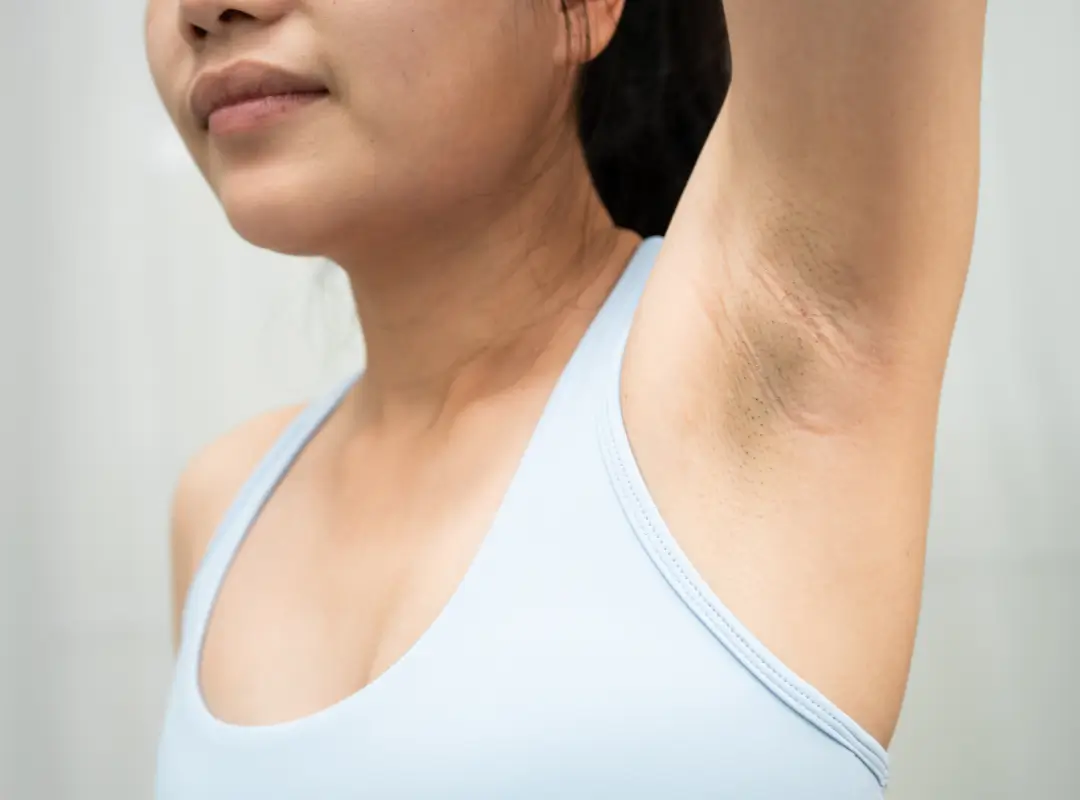How Do You Get Rid Of Dark Armpits Fast