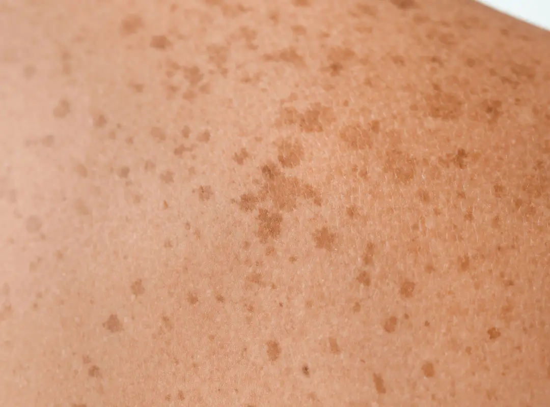 Are freckles sun damage