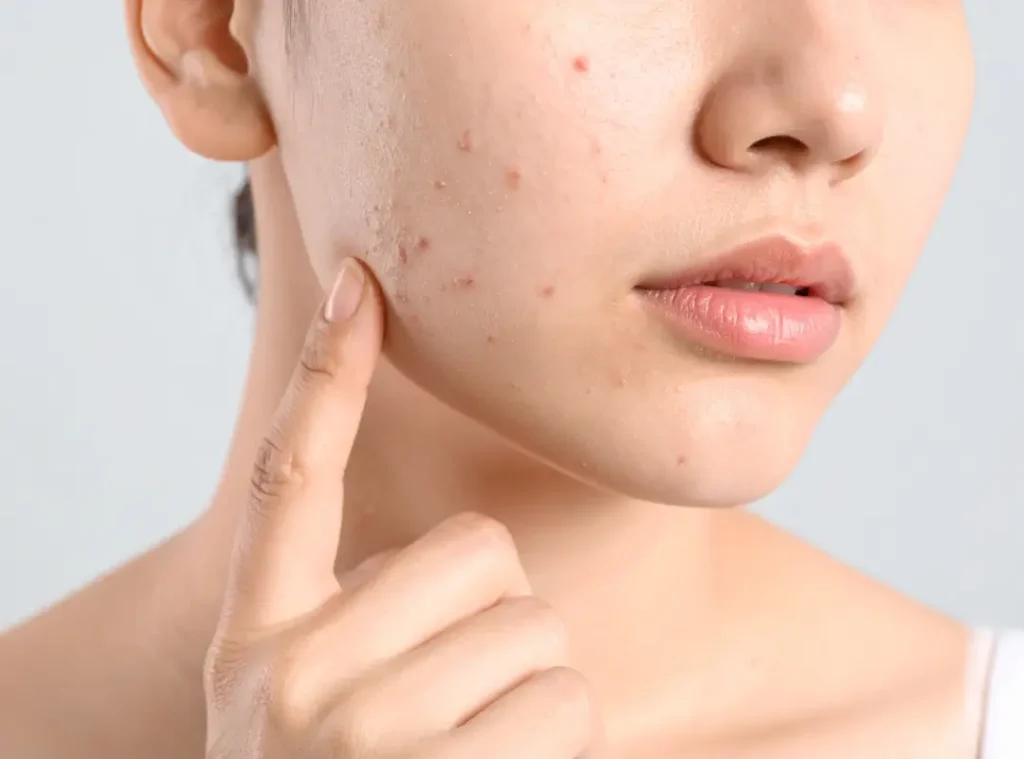 How To Clear Up Hormonal Acne