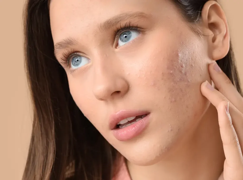 How Do You Get Rid Of Pustules Acne