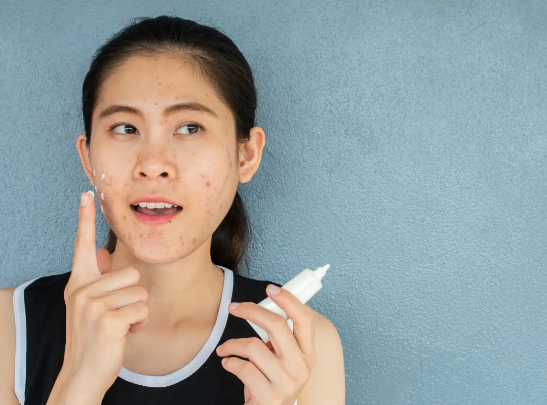 How To Treat Acne During Pregnancy