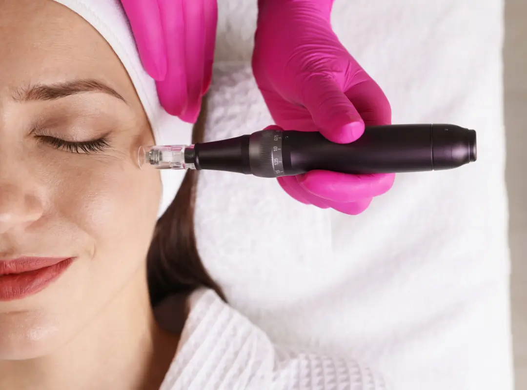 Micro-Needling and PRP in Alamo CA