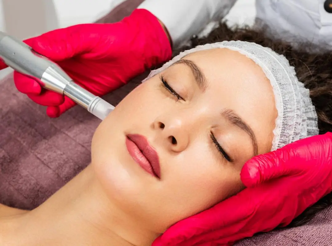Microneedling for Acne Scarring in Alamo