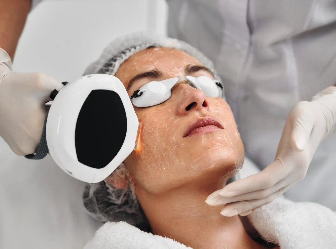 Can I Do IPL After a Chemical Peel