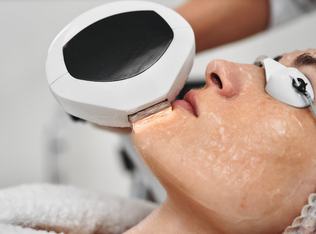 Can You Do IPL if You Use Tretinoin