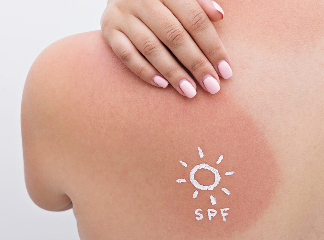 Does Peeling After Sunburn Remove Tan