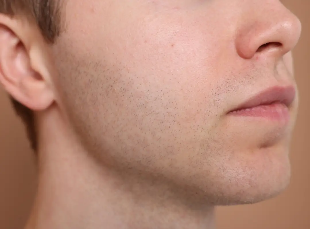Minoxidil for Beard Growth Before and After