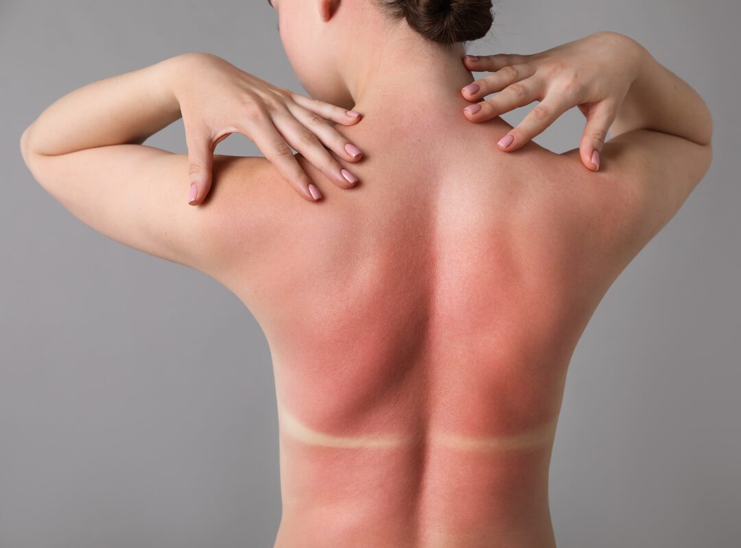 What Happens When Skin Peels After Sunburn