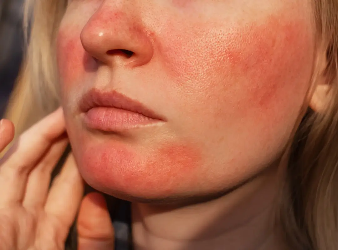 What Happens When Skin Peels After Sunburn