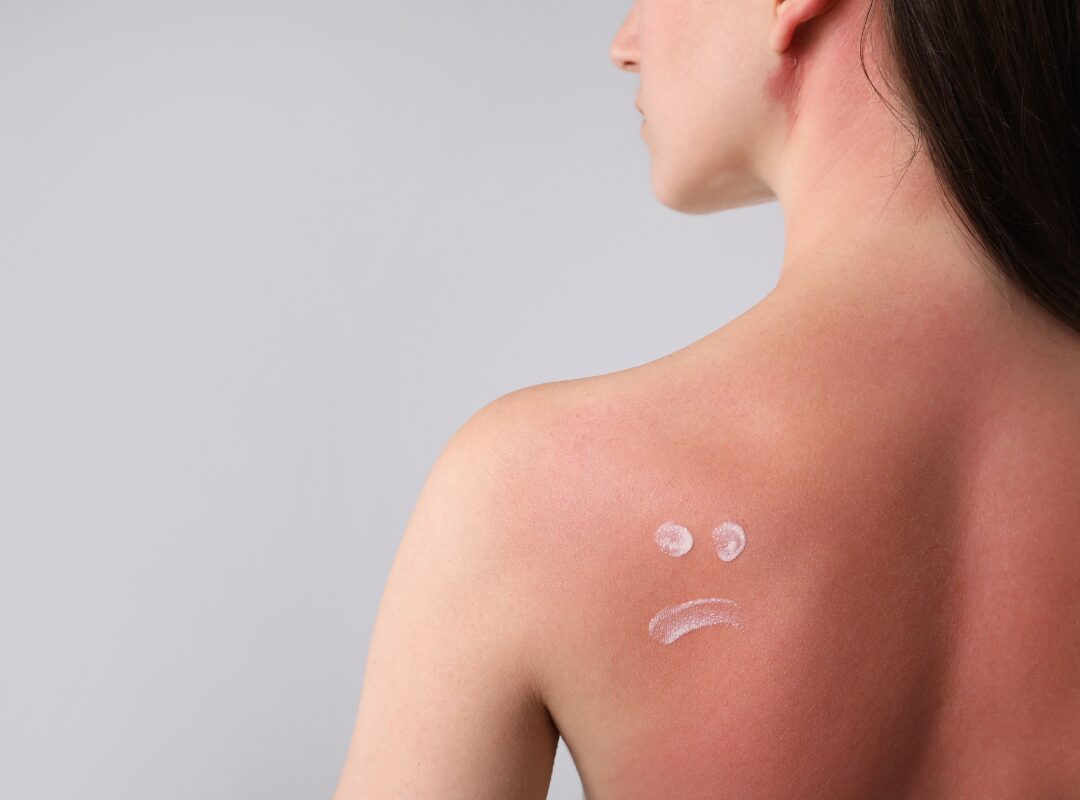 Stages of Skin Healing After Sunburn