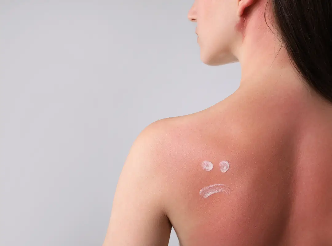 Stages of Skin Healing After Sunburn