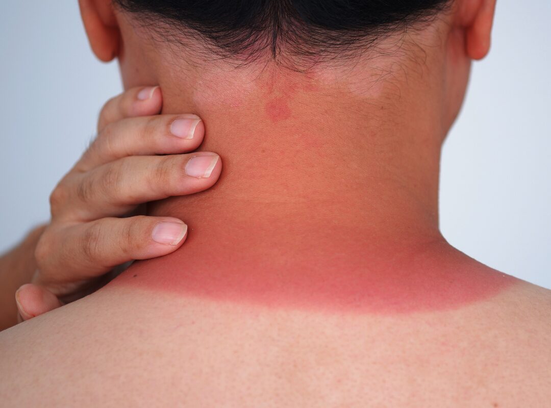 Does Sunburn Peeling Remove Tan