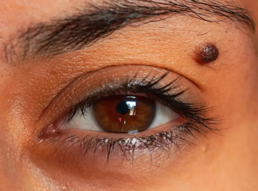 Reduce Dark Circles Skin Artistry Clinic Alamo Ca