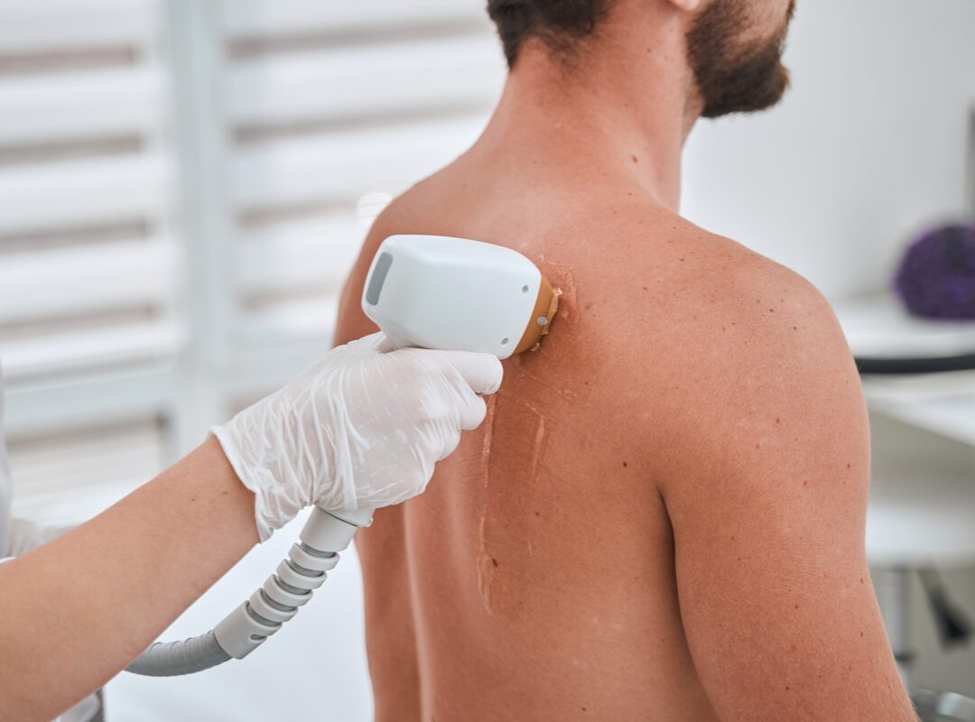 PCOS Facial Hair Treatment