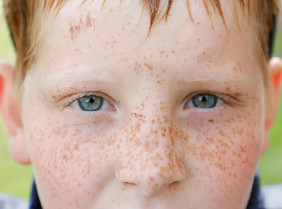 How to Reduce Freckles