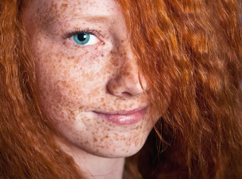 What Causes Freckles on Face