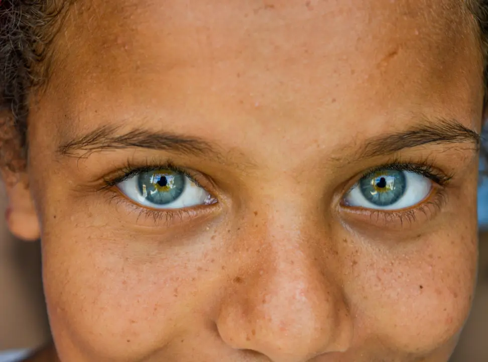 PRP for Under Eye Dark Circles