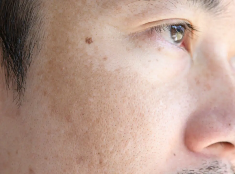 Freckles and Melanin Production