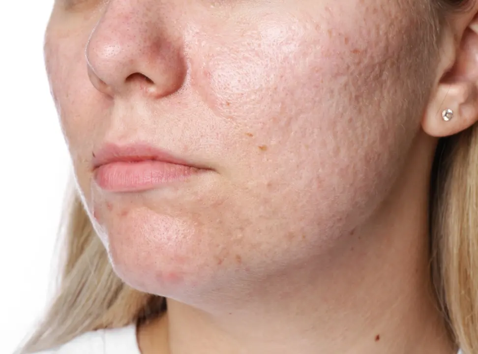 PRP Therapy for Skin Texture