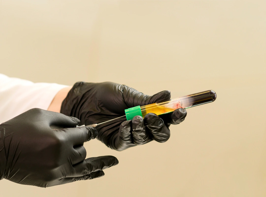 PRP Hair Treatment Danville, California