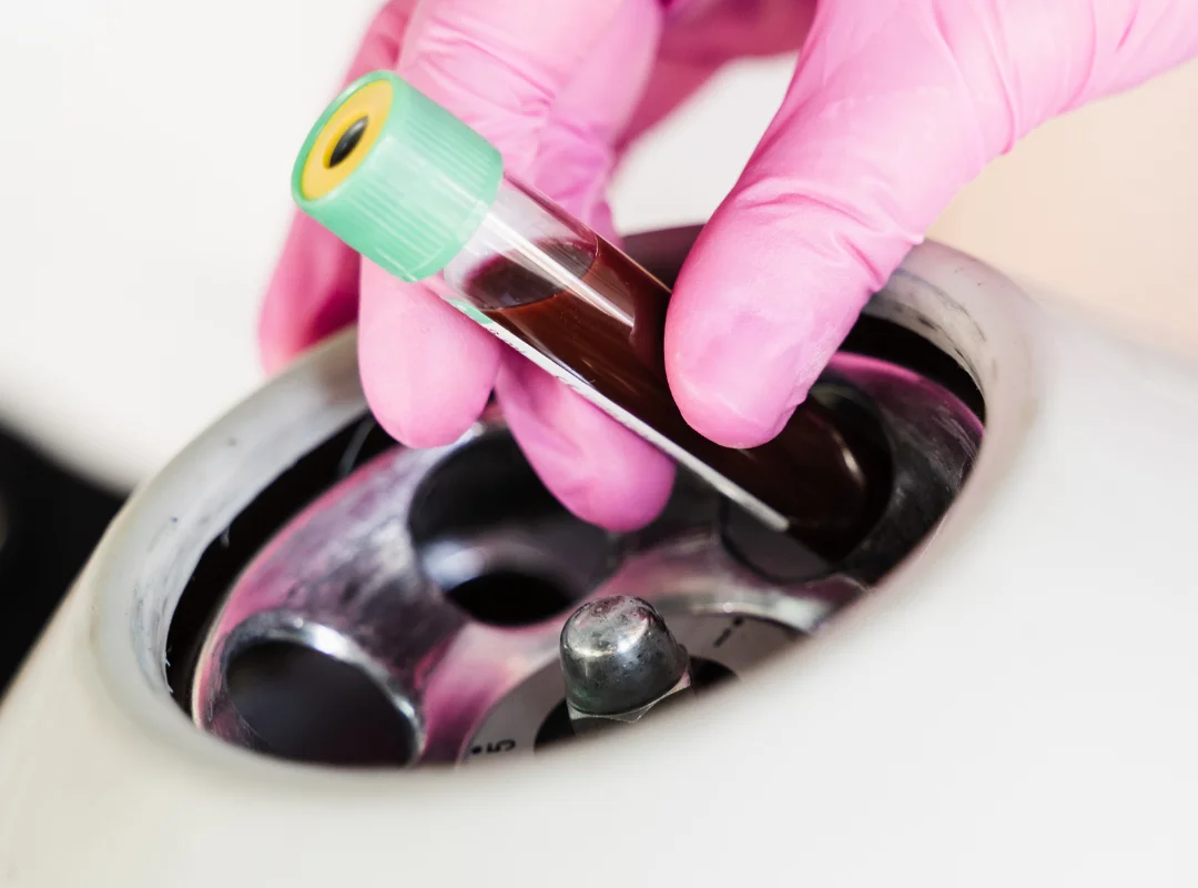 How Many Days to Recover From a PRP Facial