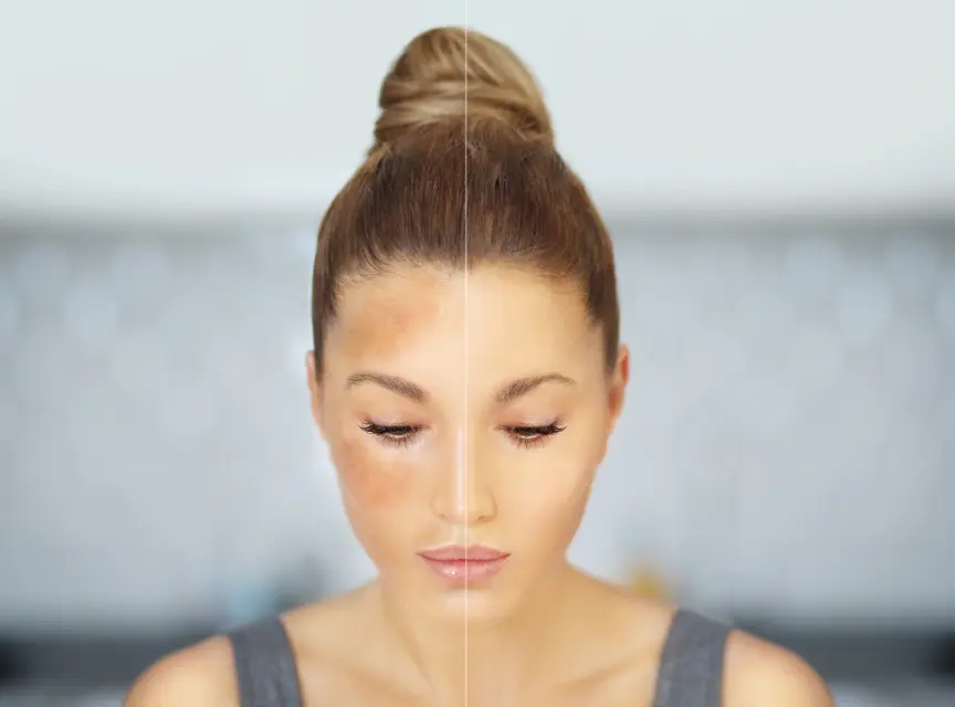 What Fades Hyperpigmentation Fastest