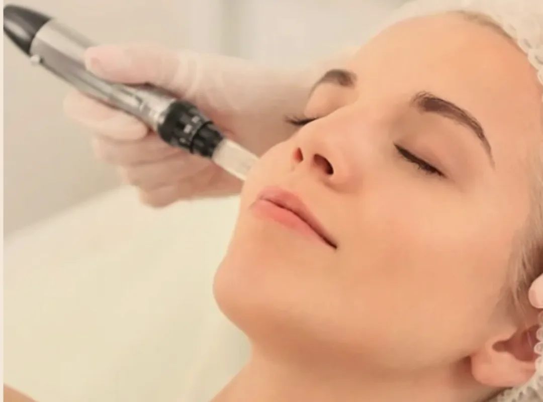 RF Microneedling For Skin Tightening