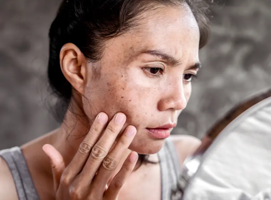 Can Hyperpigmentation Fully Go Away