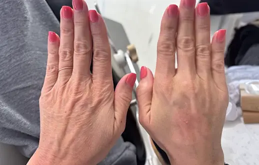 PRX Treatment for Hyperpigmentation in Alamo CA